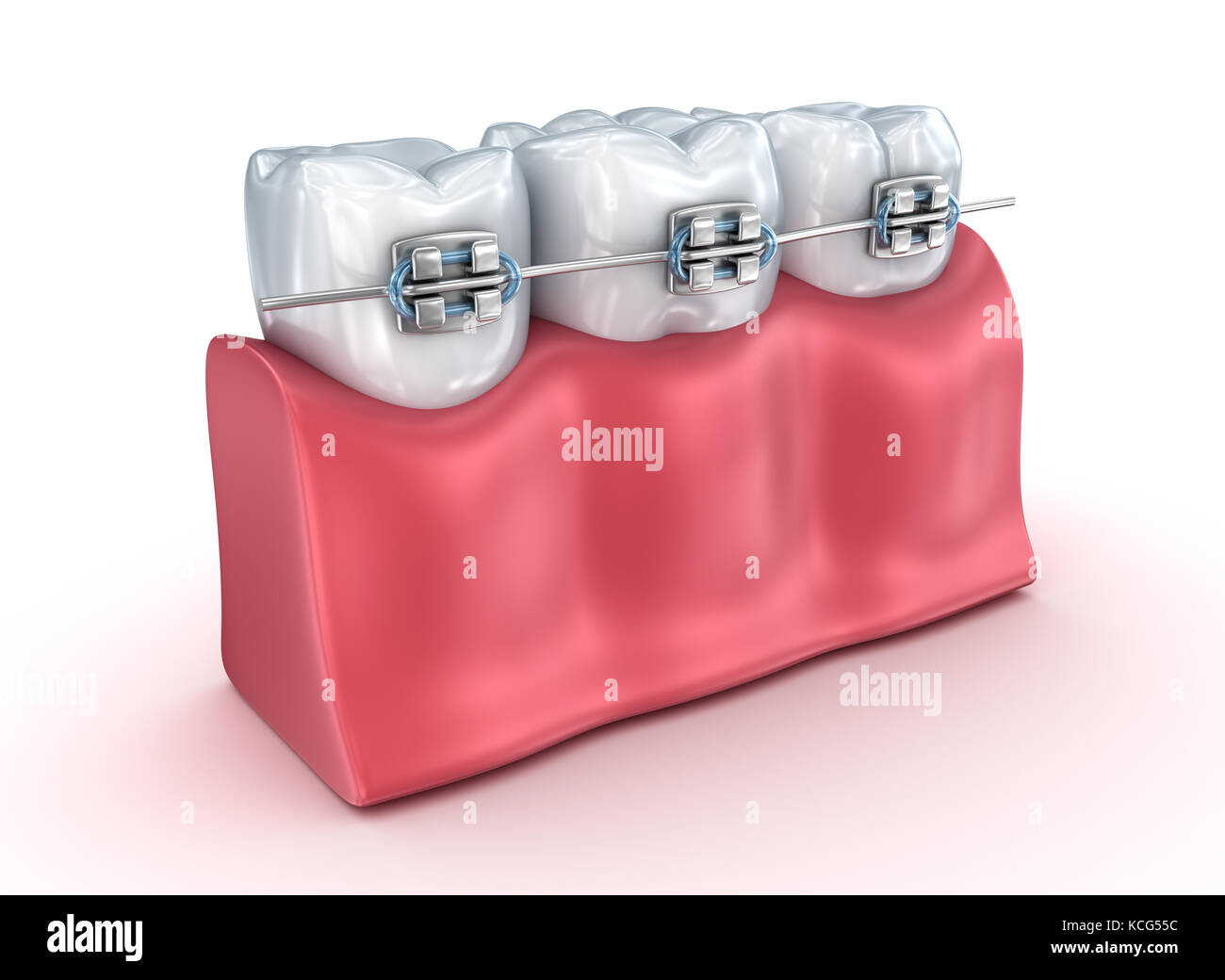 Denti con bretelle processo di allineamento. medicalmente tridimensionale accurata illustrazione Foto Stock