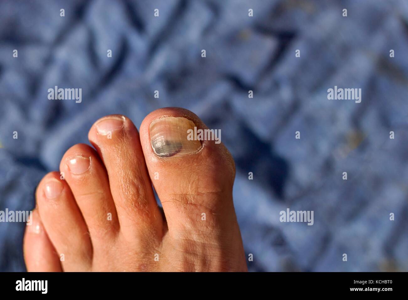 Unghie con ammaccature. Feriti il pollice sulla gamba. Di coagulo di sangue al di sotto del chiodo Foto Stock