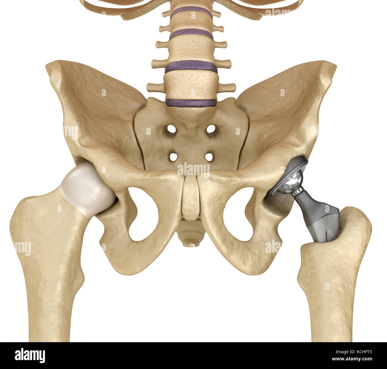 Anca sostituzione impianto installato in l'osso del bacino. Accurata dal punto di vista medico 3D illustrazione Foto Stock