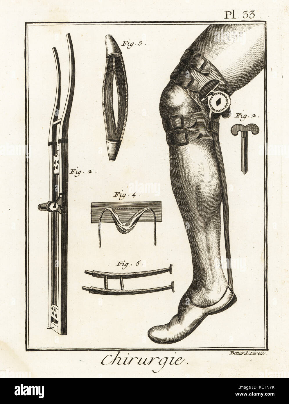 Xviii secolo chirurgico pad del ginocchio in posizione su una gamba 1, Jean Louis Petit la macchina per giunti dislocati 2-5. Incisione su rame di Robert Benard da Denis Diderot enciclopedia, pellet, Ginevra, 1779. Foto Stock