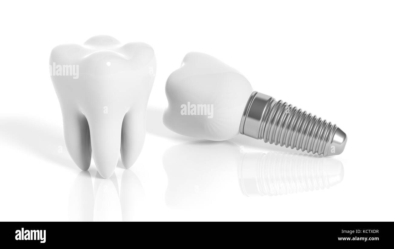 Dente e impianto dentale isolati su sfondo bianco Foto Stock