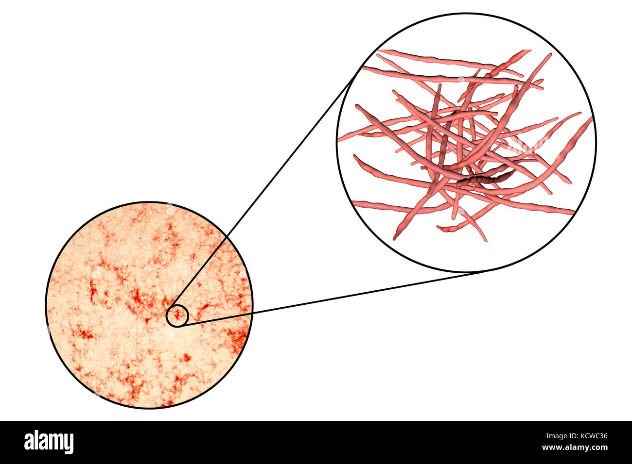 Actinomicete batteri, microfotografia e illustrazione del computer. Filamentosa questi batteri Gram positivi formano un fungo-come stuoia o micelio. Actinomicete sono i batteri saprofiti normalmente, alimentazione off decadendo questione nel suolo e habitat acquatici. Essi sono inoltre normalmente presenti sulle gengive e può causare infezioni dopo le procedure dentistiche. Actinomyces israelii è l'agente eziologico di actinomycosis, una infezione granulomatosa caratterizzata dalla formazione di ascessi. Foto Stock