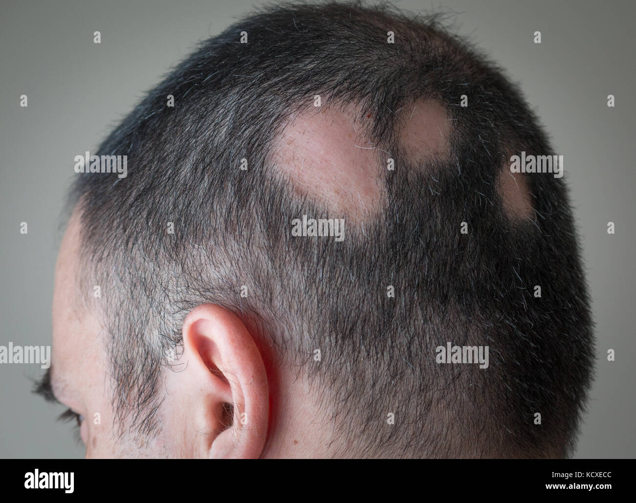 Alopecia aerata - spot calvizie Foto Stock