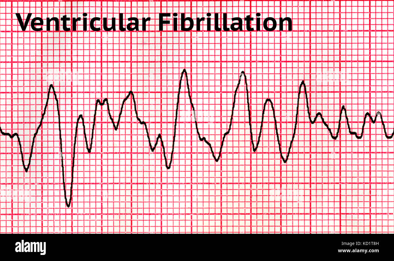 La fibrillazione ventricolare (VF) Foto Stock