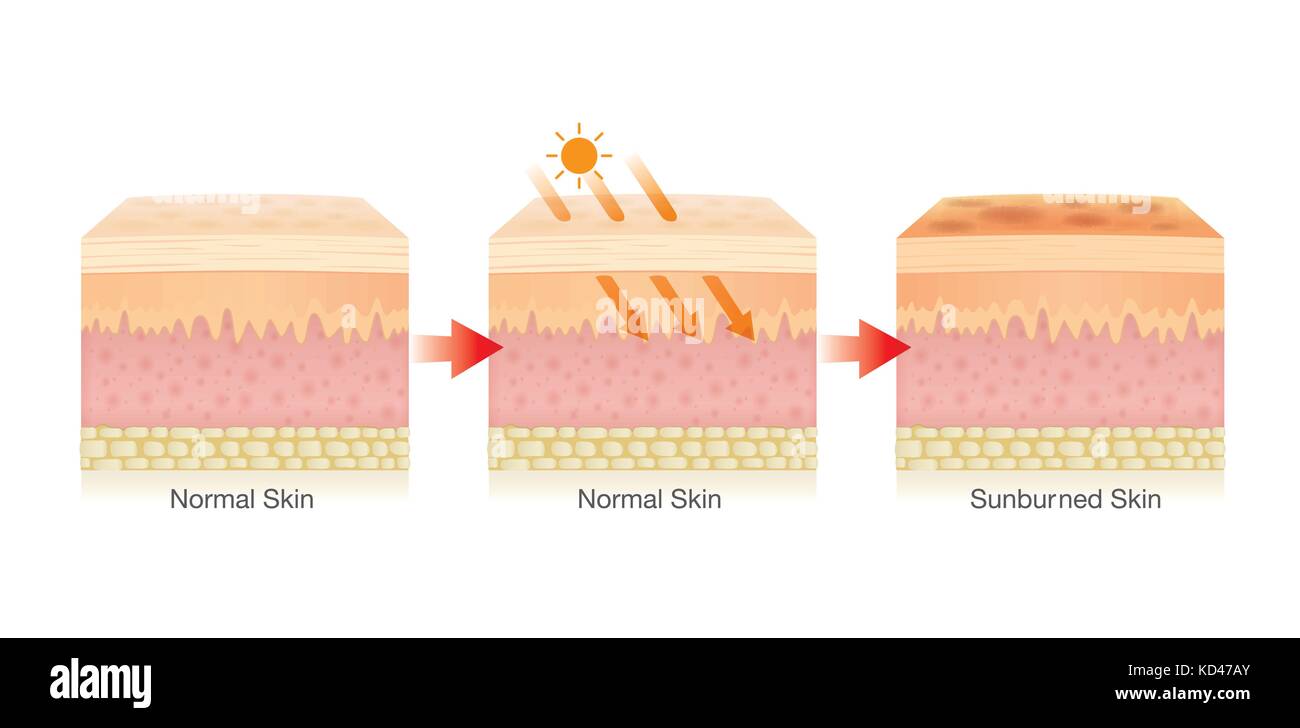 Modifica della pelle umana strato danneggiato dalla luce del sole. Illustrazione Vettoriale