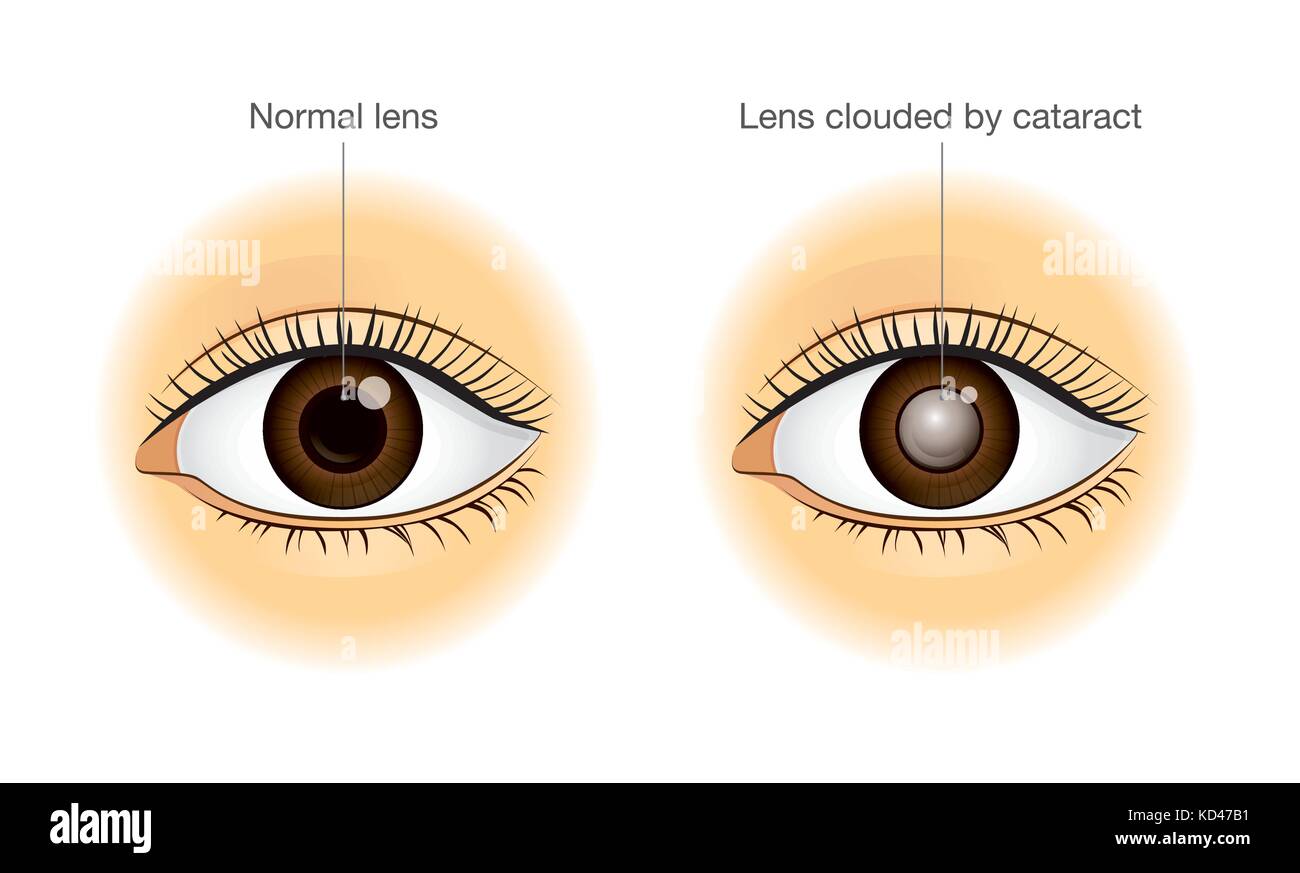Occhio normale e la lente offuscato da cataratta. Illustrazione Vettoriale