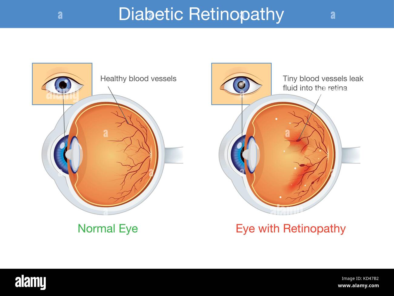 Anatomia di occhio normale e retinopatia diabetica. Illustrazione Vettoriale