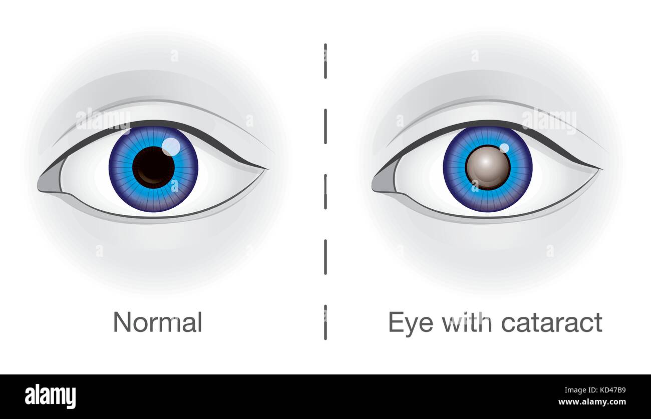 Occhio normale e la lente offuscato da cataratta. Illustrazione Vettoriale