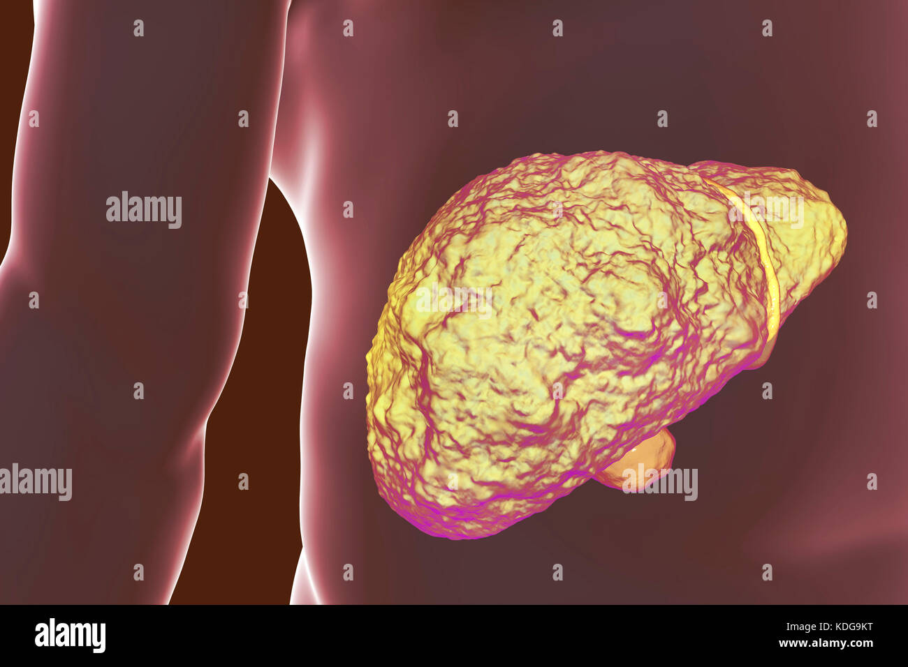 Fegato con cirrosi epatica, illustrazione del computer. La cirrosi è una conseguenza di malattie croniche di fegato caratterizzata da fibrosi e cicatrizzazione del tessuto. Foto Stock
