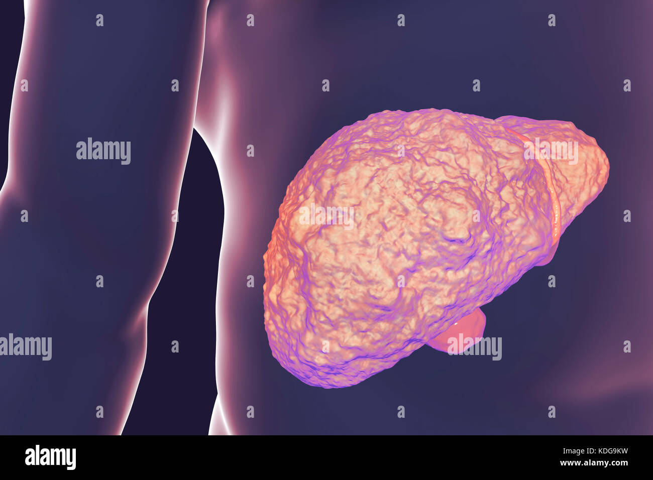 Fegato con cirrosi epatica, illustrazione del computer. La cirrosi è una conseguenza di malattie croniche di fegato caratterizzata da fibrosi e cicatrizzazione del tessuto. Foto Stock