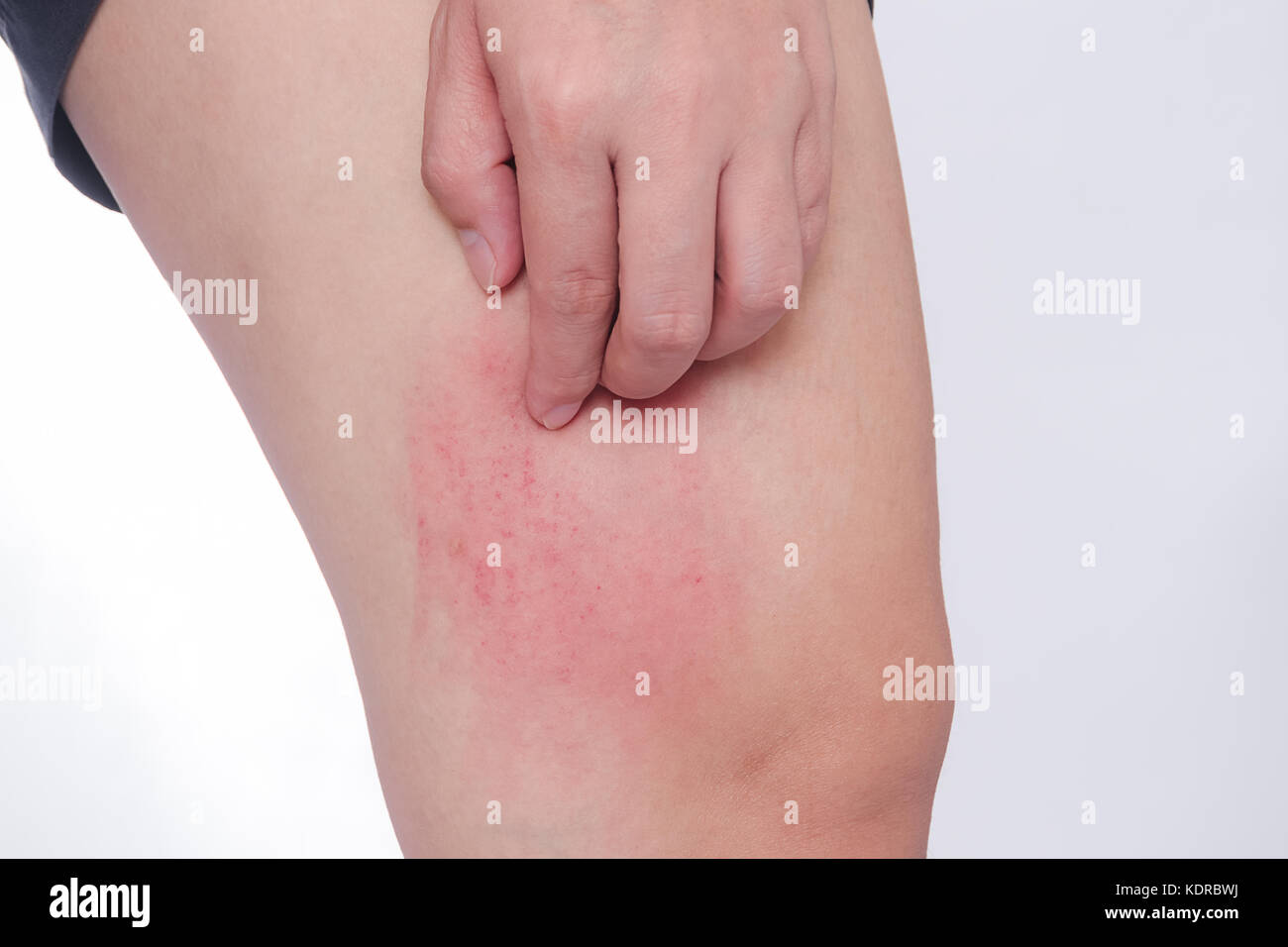 Graffiare la pelle allergiche da punture di zanzara Foto stock - Alamy