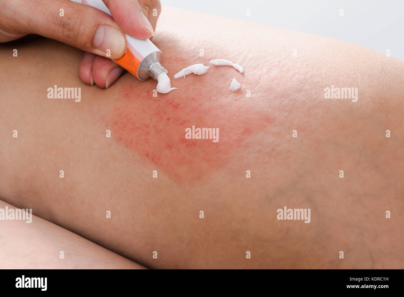 Graffiare la pelle allergiche da zanzara o punture di insetti e applicare la crema della medicina,la sanità e la medicina concpet Foto Stock
