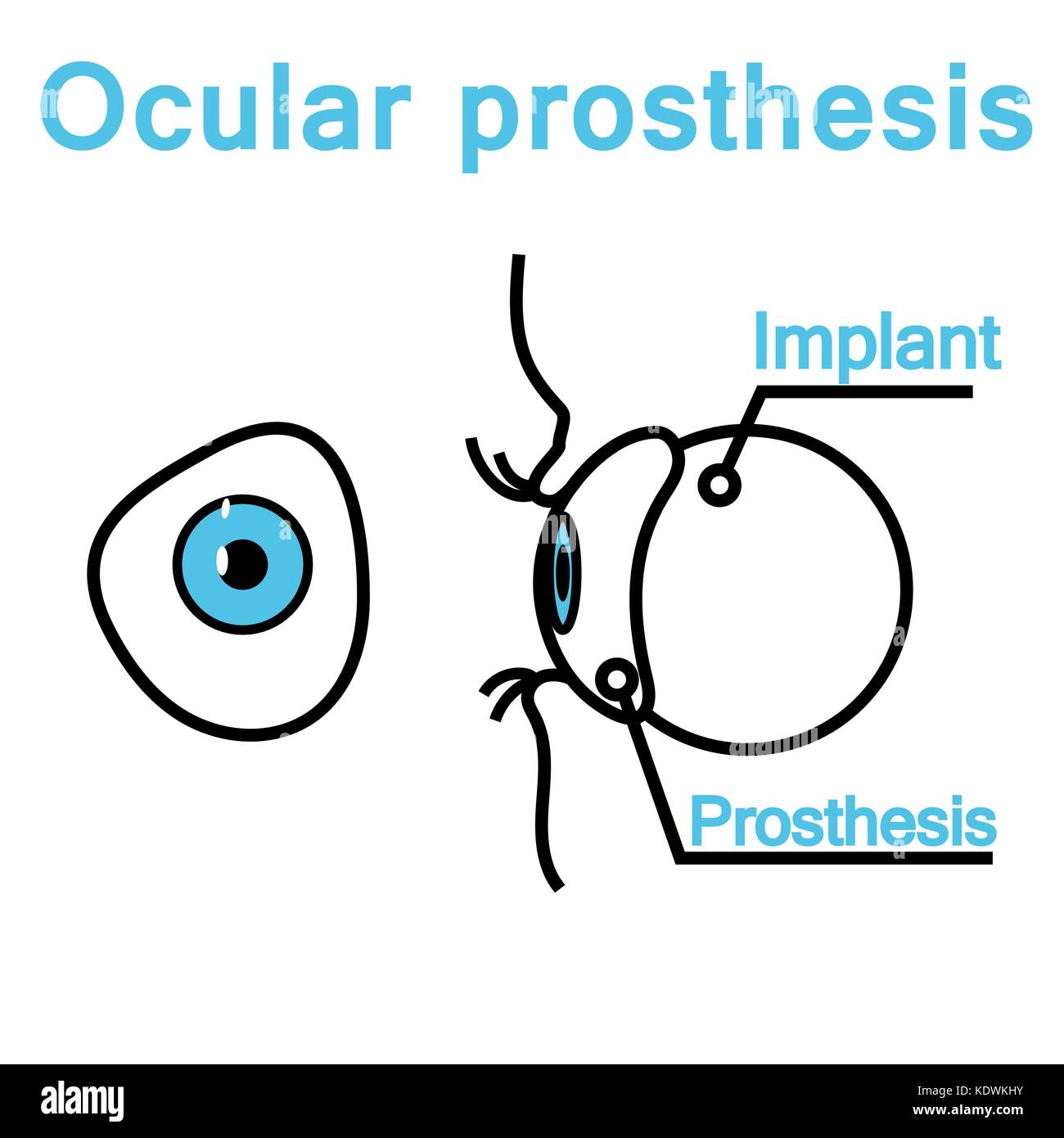 Illustrazione di una protesi oculare Illustrazione Vettoriale