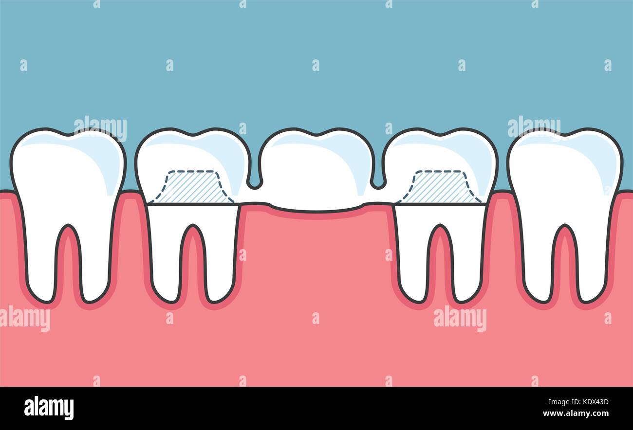 Ponte dentale e la fila di denti Illustrazione Vettoriale