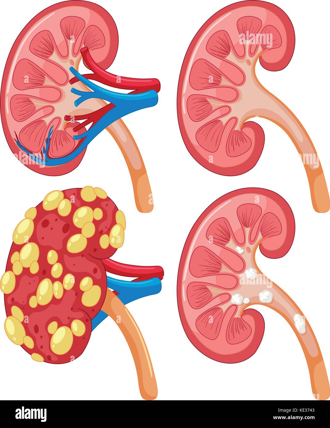 Schema del rene con malattia illustrazione Illustrazione Vettoriale