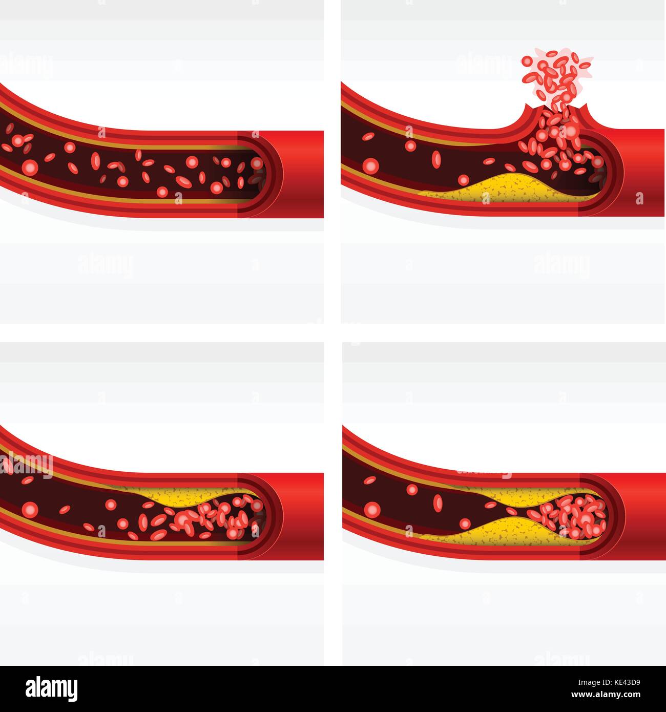 Tratto di arteria con colesterolo e trombosi, ictus cerebrale e di attacco di cuore Illustrazione Vettoriale