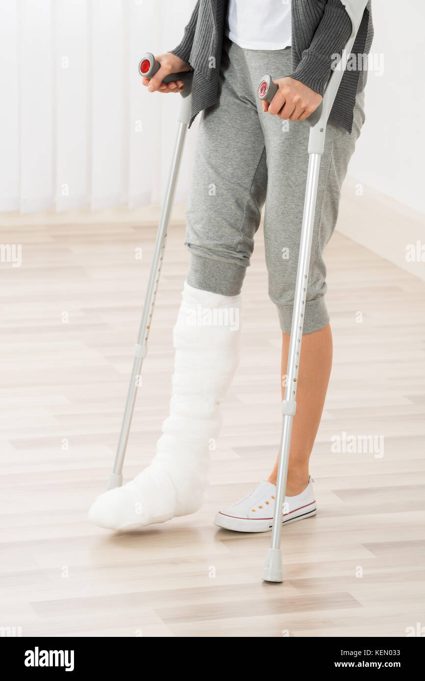 Close-up di donna gamba nel calco in gesso usando stampelle mentre si  cammina Foto stock - Alamy