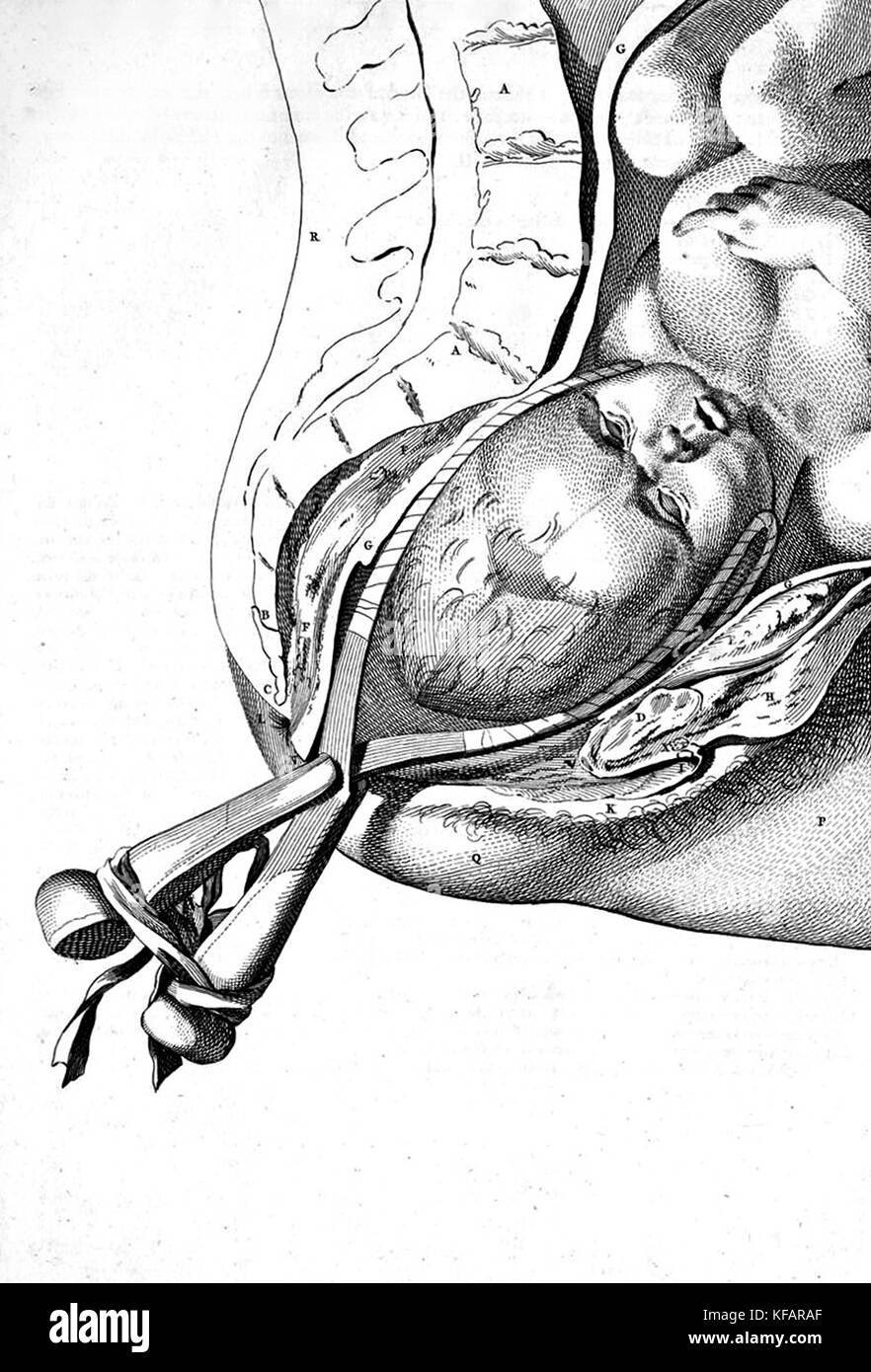 Disegno di parto con uso di forcipi di William Smellie 1754 Foto Stock
