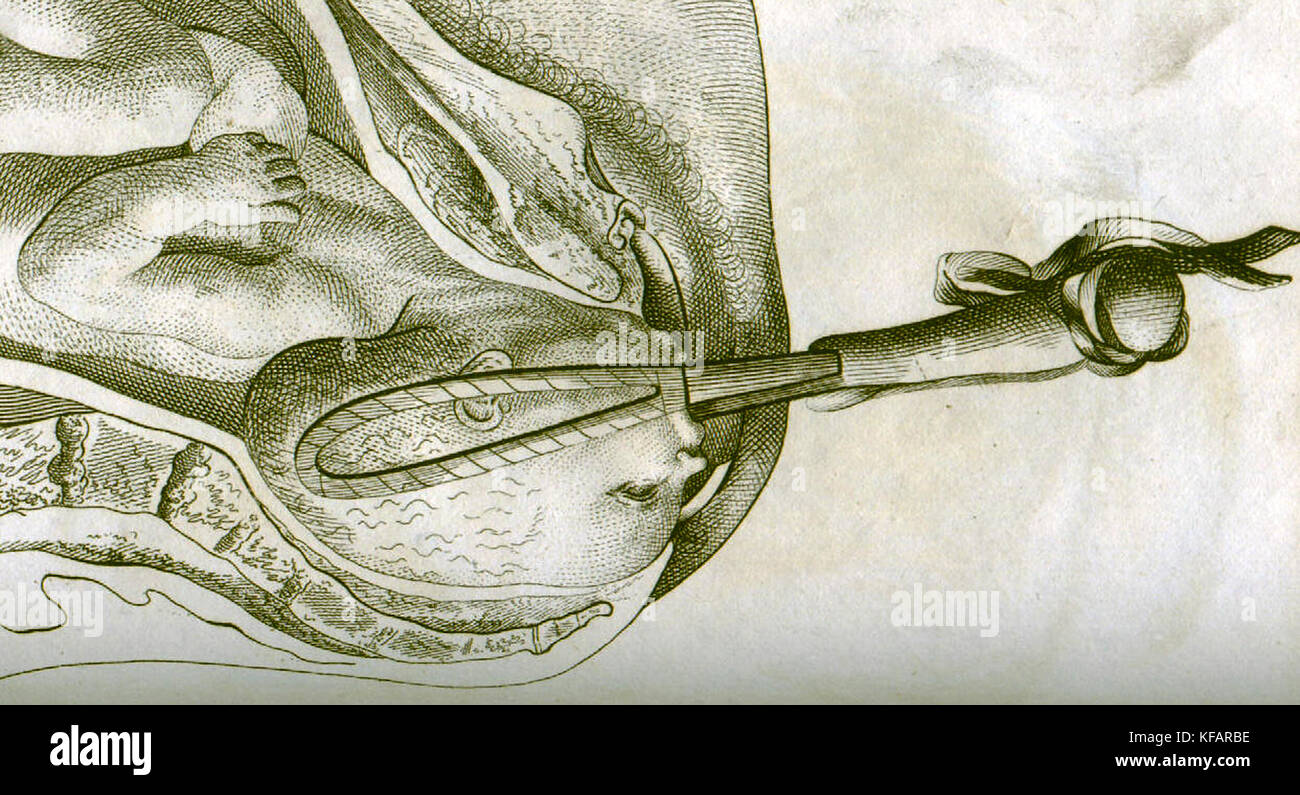 Disegno del parto con uso di una pinza da William smellie, ostetrico forcipi (1792) Foto Stock