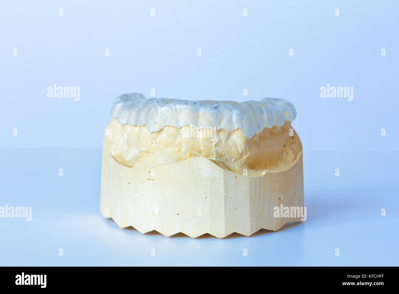 Smerigliare la protezione realizzata in plastica chiara su un custom-made modello di dente, utilizzato contro una eccessiva usura causata dal bruxismo Foto Stock