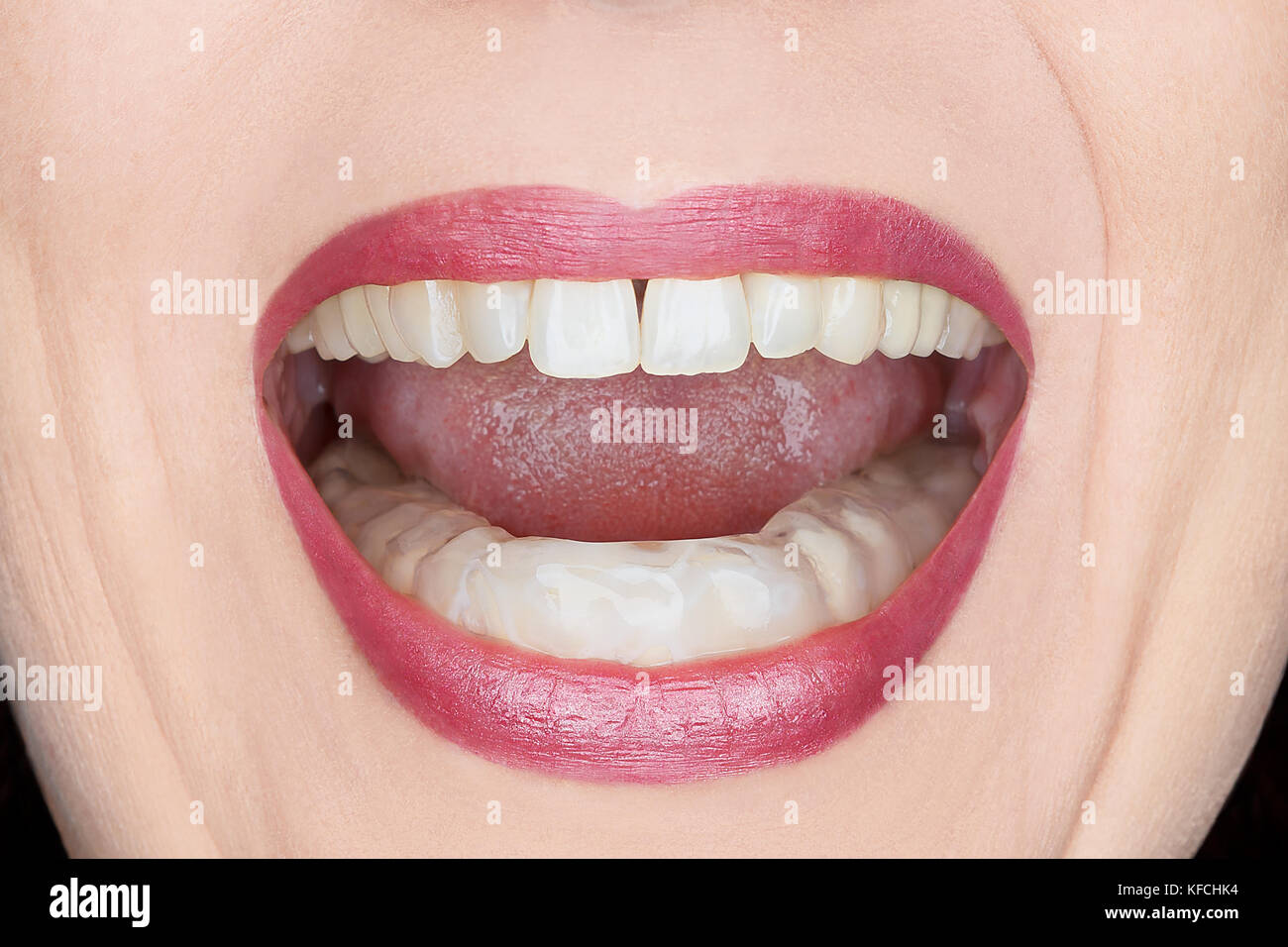 Primo piano di una donna aperta la bocca in plastica con protezione dei denti di arresto per usura dovuta alla macinazione di notte, causato da una tensione eccessiva Foto Stock