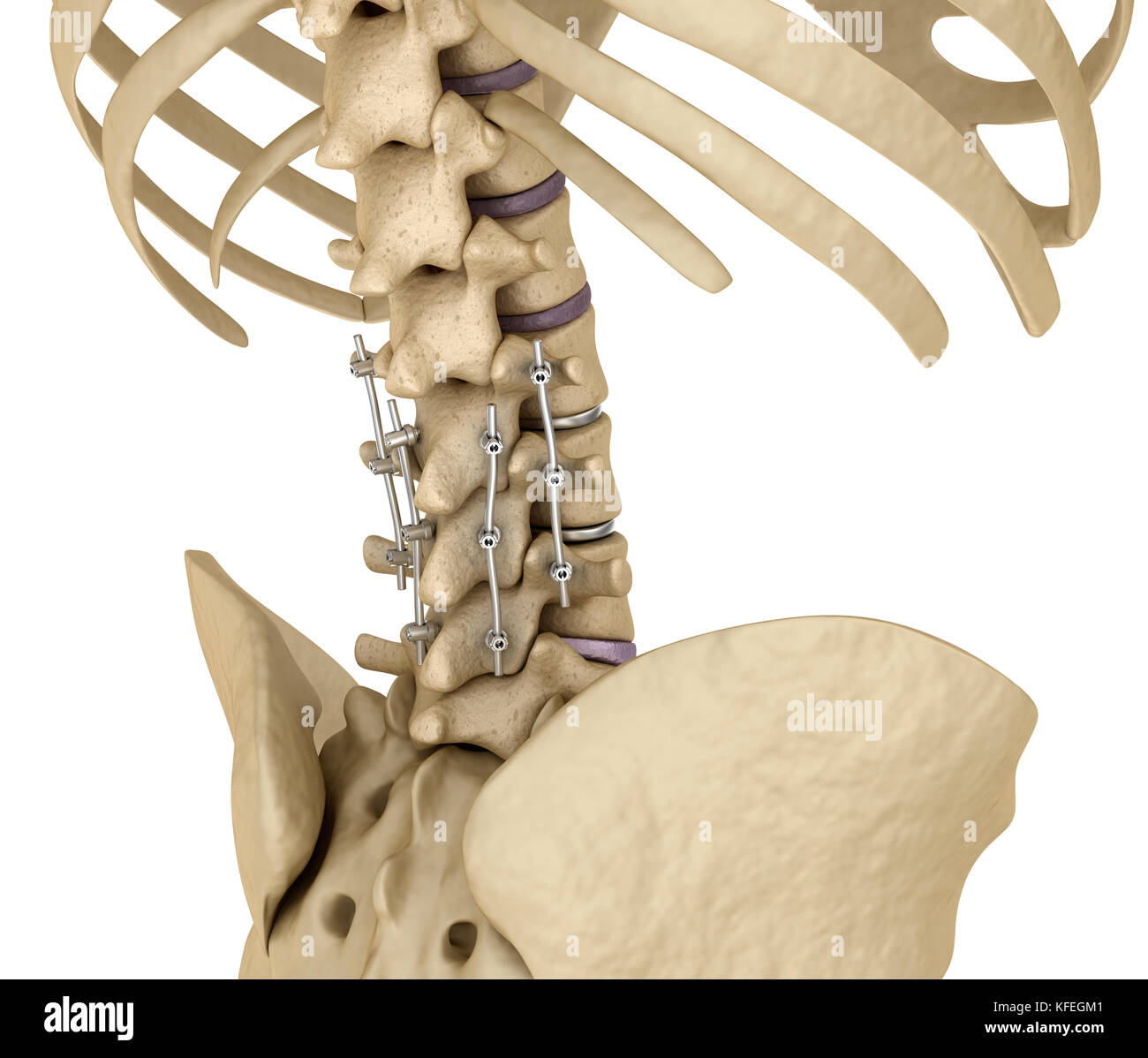 Fissazione spinale sistema - staffa di titanio. Accurata dal punto di vista medico dente 3D illustrazione Foto Stock