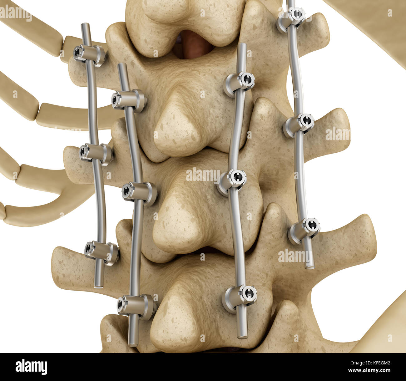 Fissazione spinale sistema - staffa di titanio. Accurata dal punto di vista medico dente 3D illustrazione Foto Stock