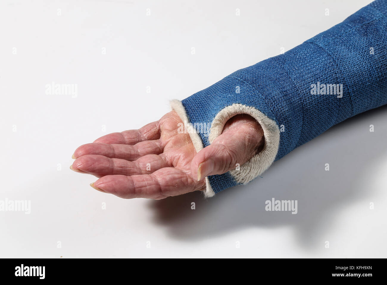 Onorevoli braccio con la rottura di un polso con una pentola a. Foto Stock