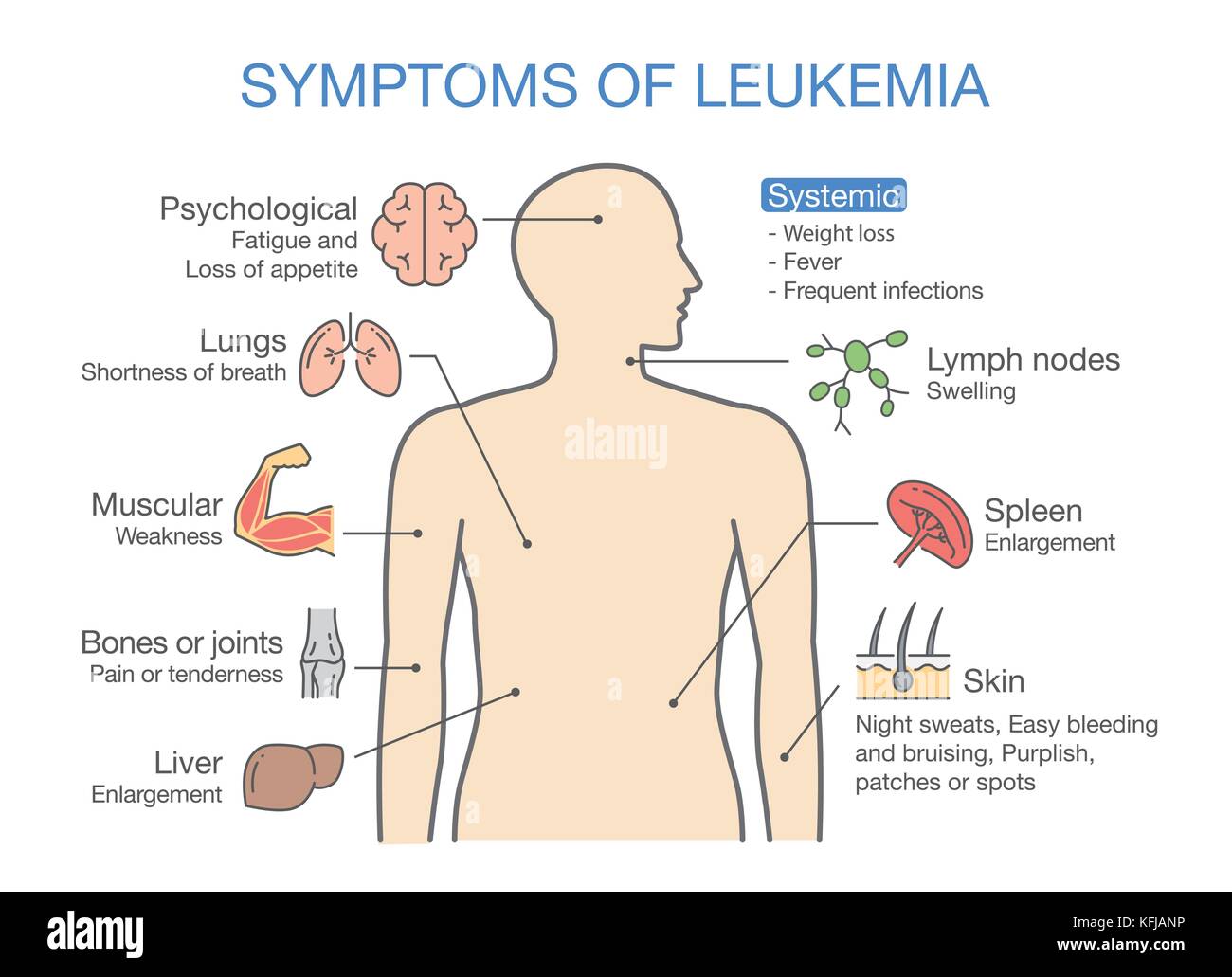 I più comuni sintomi e segni di leucemia. Illustrazione Vettoriale
