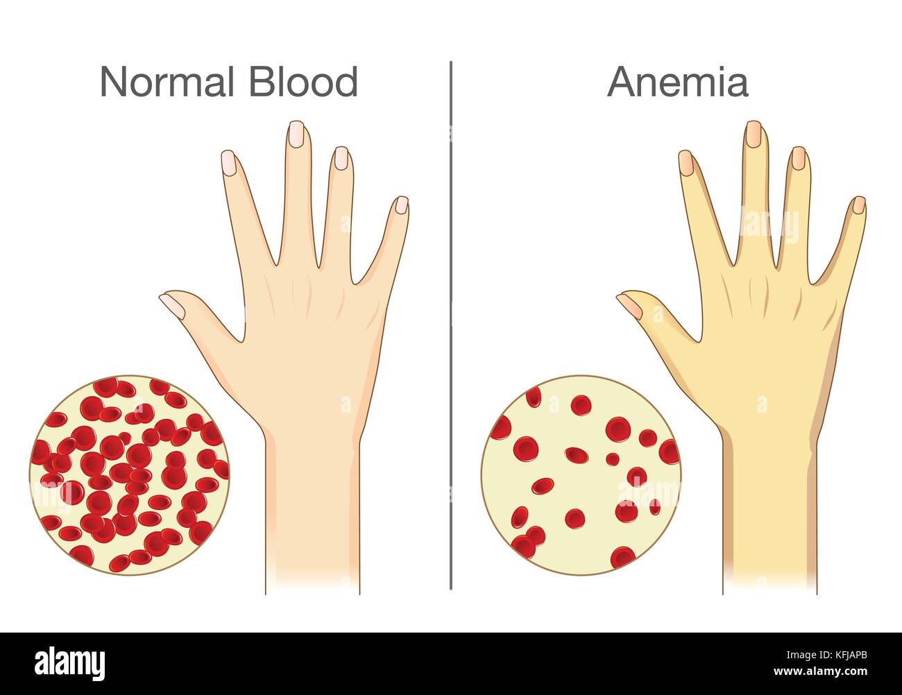 L'effetto di anemia sulla pelle il flusso di sangue in un essere umano. Illustrazione Vettoriale