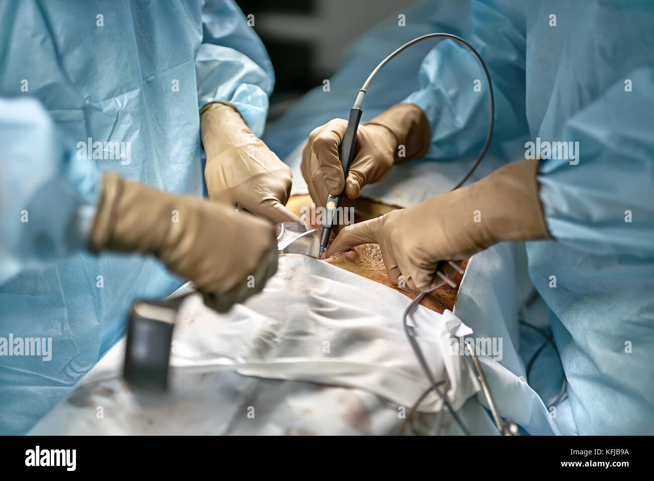 Il chirurgo è utilizzando un bisturi laser mentre assistant è in possesso  di un retrattore chirurgico durante il funzionamento addominale. dello  stomaco del paziente coperta con iodio Foto stock - Alamy