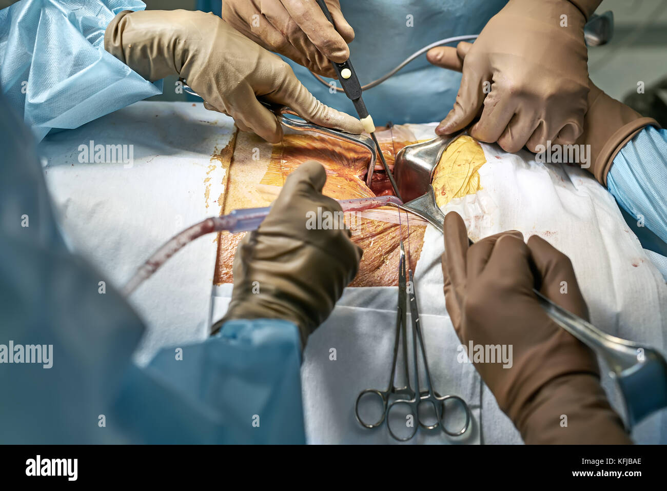 Il chirurgo è utilizzando un bisturi laser in una cavità di un dello  stomaco del paziente durante l'operazione addominale. assistenti stanno  utilizzando i riavvolgitori chirurgico e medico Foto stock - Alamy