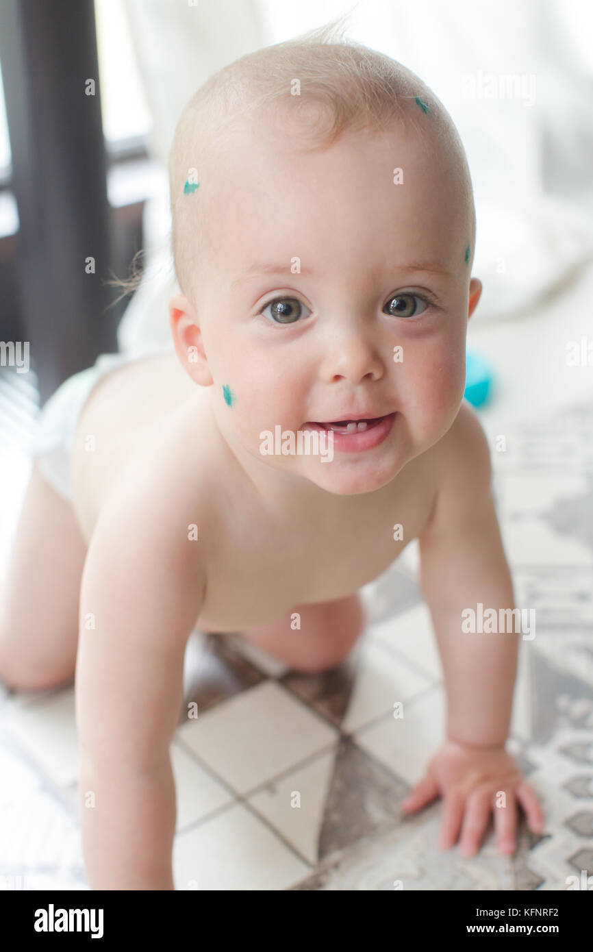 Bambino con la varicella rash Foto Stock