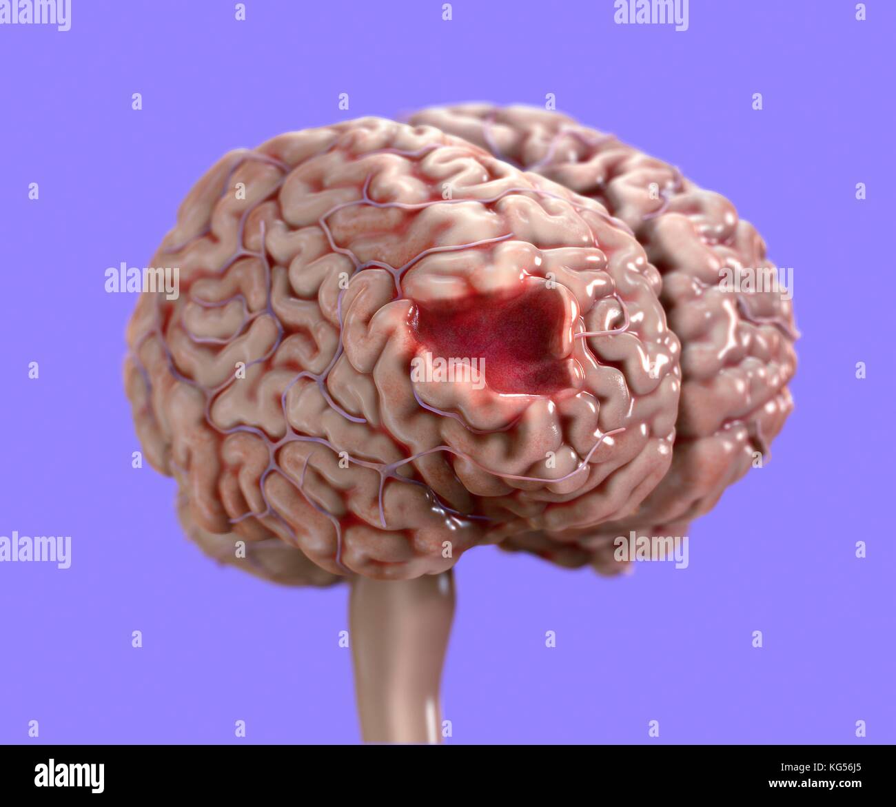 Cervello umano danni, illustrazione. Foto Stock