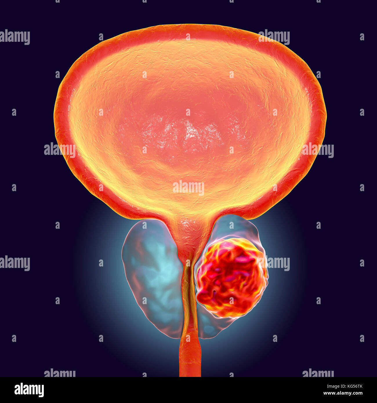 Il cancro della prostata. Computer illustrazione di un tumore canceroso (centro destra) nella ghiandola della prostata (trasparente, centro). L'uretra può essere visto correre verso il centro della prostata, dalla vescica (top). Il cancro della prostata è uno dei più comuni cancri maschio, che di norma colpisce le persone anziane. La crescita di un tumore della prostata possono ostruire il collo della vescica, pregiudicando la minzione. Tuttavia è una lenta crescita del cancro. Se diagnosticata, trattamento comporta un intervento chirurgico per rimuovere la ghiandola della prostata o la radioterapia. Recenti ricerche mostrano il legame tra il cancro della prostata e infezione del virus, Foto Stock