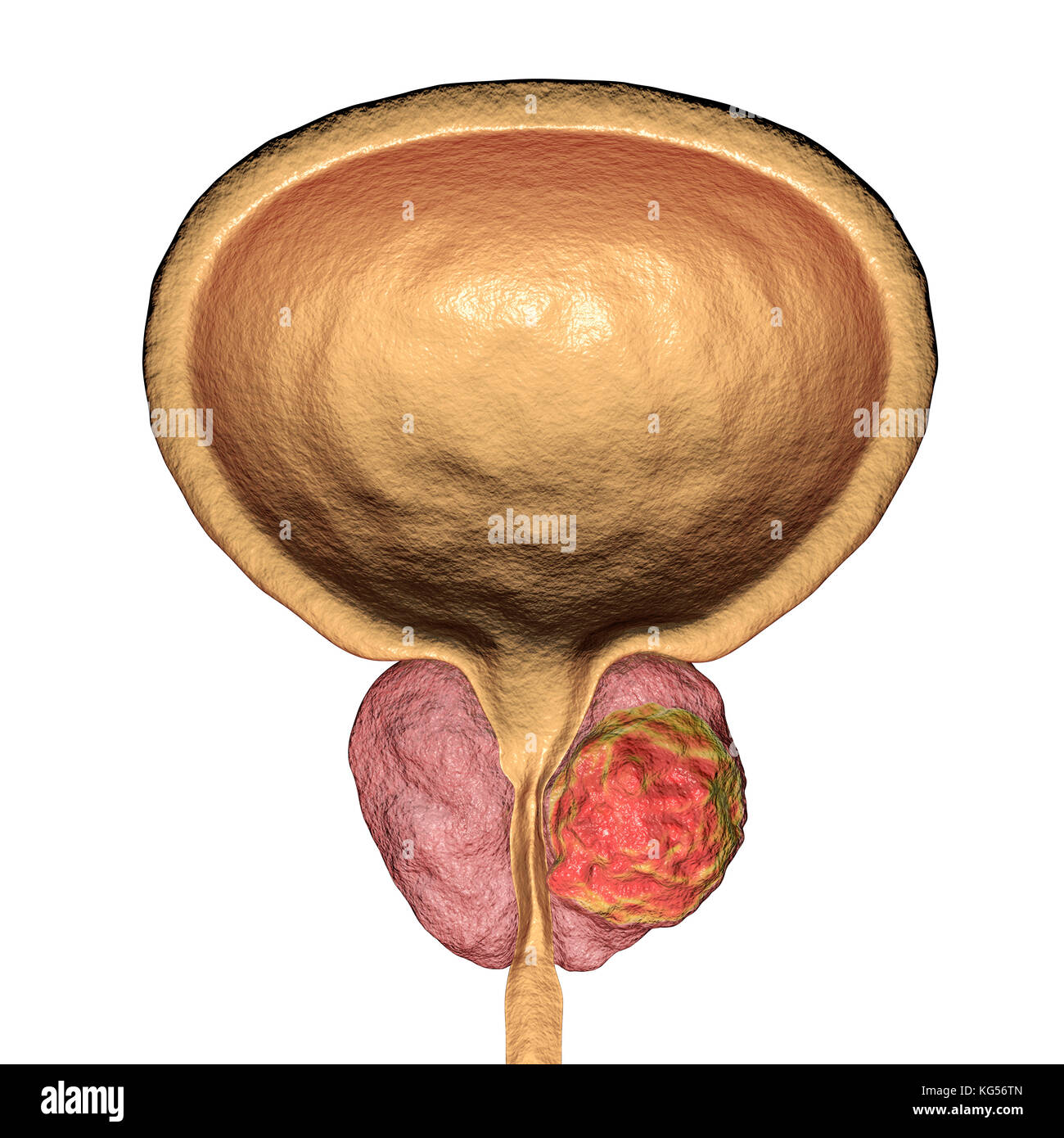 Il cancro della prostata. Computer illustrazione di un tumore canceroso (centro destra) nella ghiandola della prostata (rosa, centro). L'uretra può essere visto correre verso il centro della prostata, dalla vescica (top). Il cancro della prostata è uno dei più comuni cancri maschio, che di norma colpisce le persone anziane. La crescita di un tumore della prostata possono ostruire il collo della vescica, pregiudicando la minzione. Tuttavia è una lenta crescita del cancro. Se diagnosticata, trattamento comporta un intervento chirurgico per rimuovere la ghiandola della prostata o la radioterapia. Foto Stock