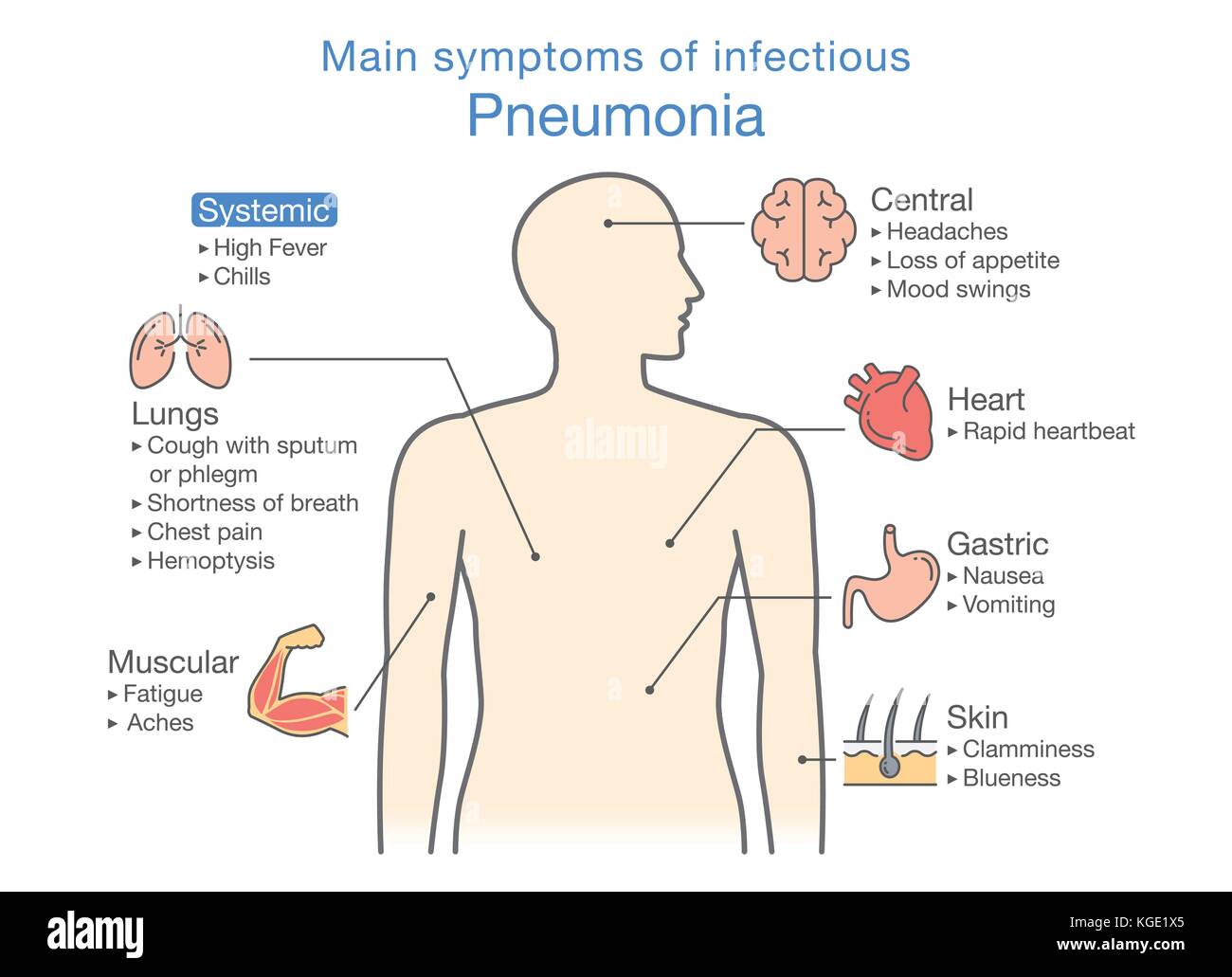 Schema dei principali sintomi di polmonite infettiva. Illustrazione Vettoriale