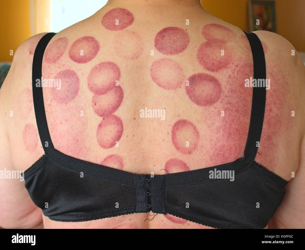 Rosso scuro cerchio punti sulla donna pelle indietro dopo medical  coppettazione massaggio Foto stock - Alamy