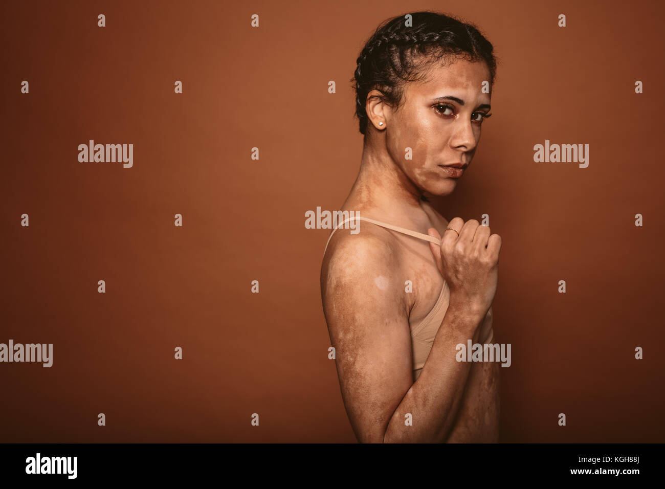 Giovane donna con la vitiligine malattia in piedi contro lo sfondo di colore marrone. Modello femminile con vitiligo pigmentazione interessato sul corpo. Foto Stock