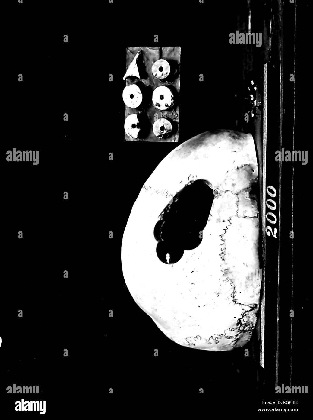 Fotografia medica del cranio di un soldato dalla guerra civile americana, che mostra lesioni da sparo al cranio e un tentativo di riparazione chirurgica, 1865. Il paziente sopravvisse all'intervento ma morì 12 ore dopo, New York. Archivio Internet di cortesia. Foto Stock