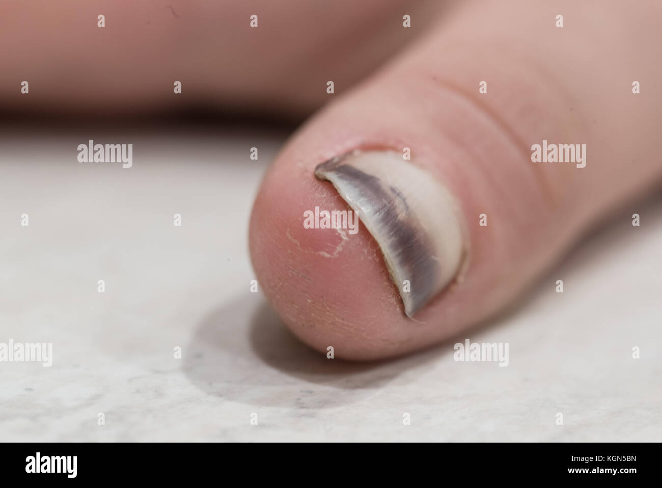 Picchiati dark pollice unghie vista ravvicinata Foto Stock