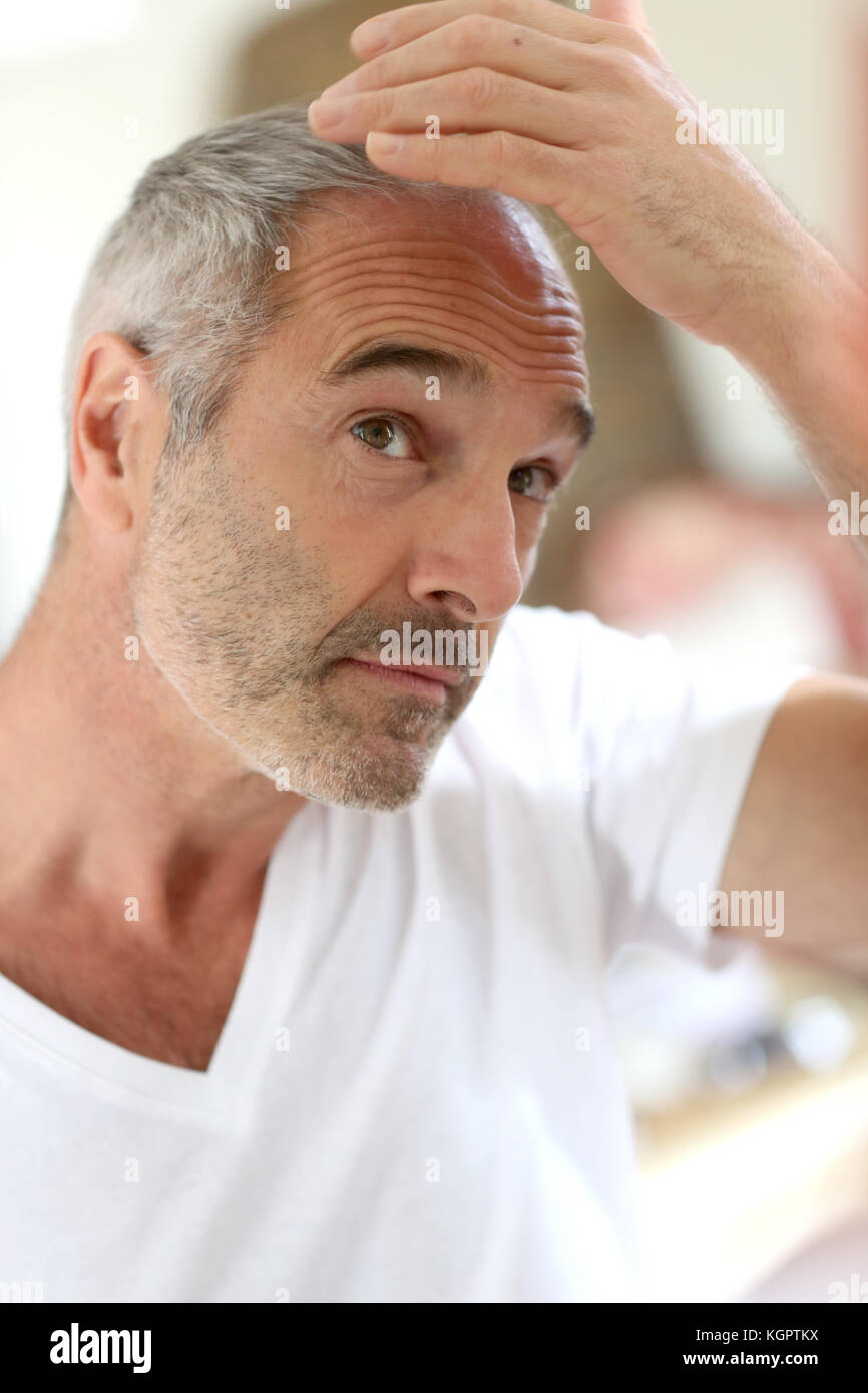 Senior l uomo e la perdita di capelli problema Foto Stock