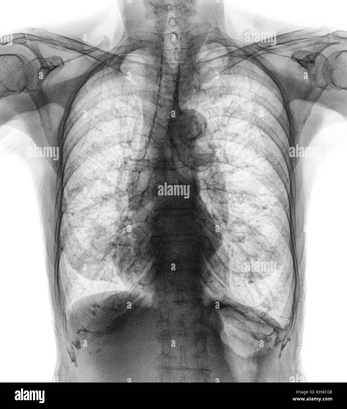 Radiografia toracica normale di un paziente anziano . Si può vedere calcificazione a costola , trachea , bronco . Vista frontale . Foto Stock