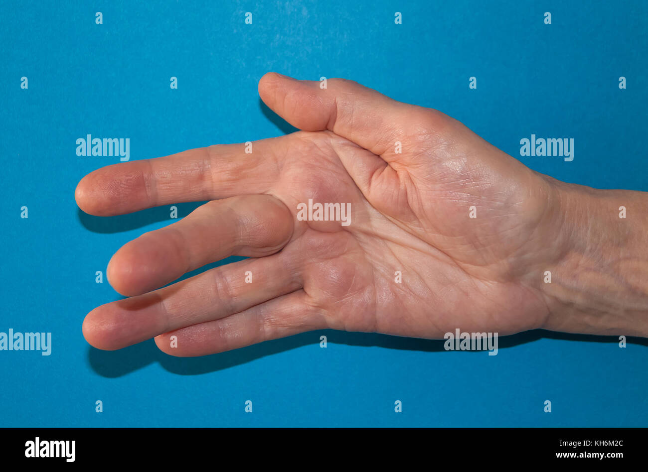 Dupuytren contrattura della deformità: una cordicella nel palmo della mano (con un nodulo duro alla base del dito medio) tira il dito in posizione piegata. Foto Stock
