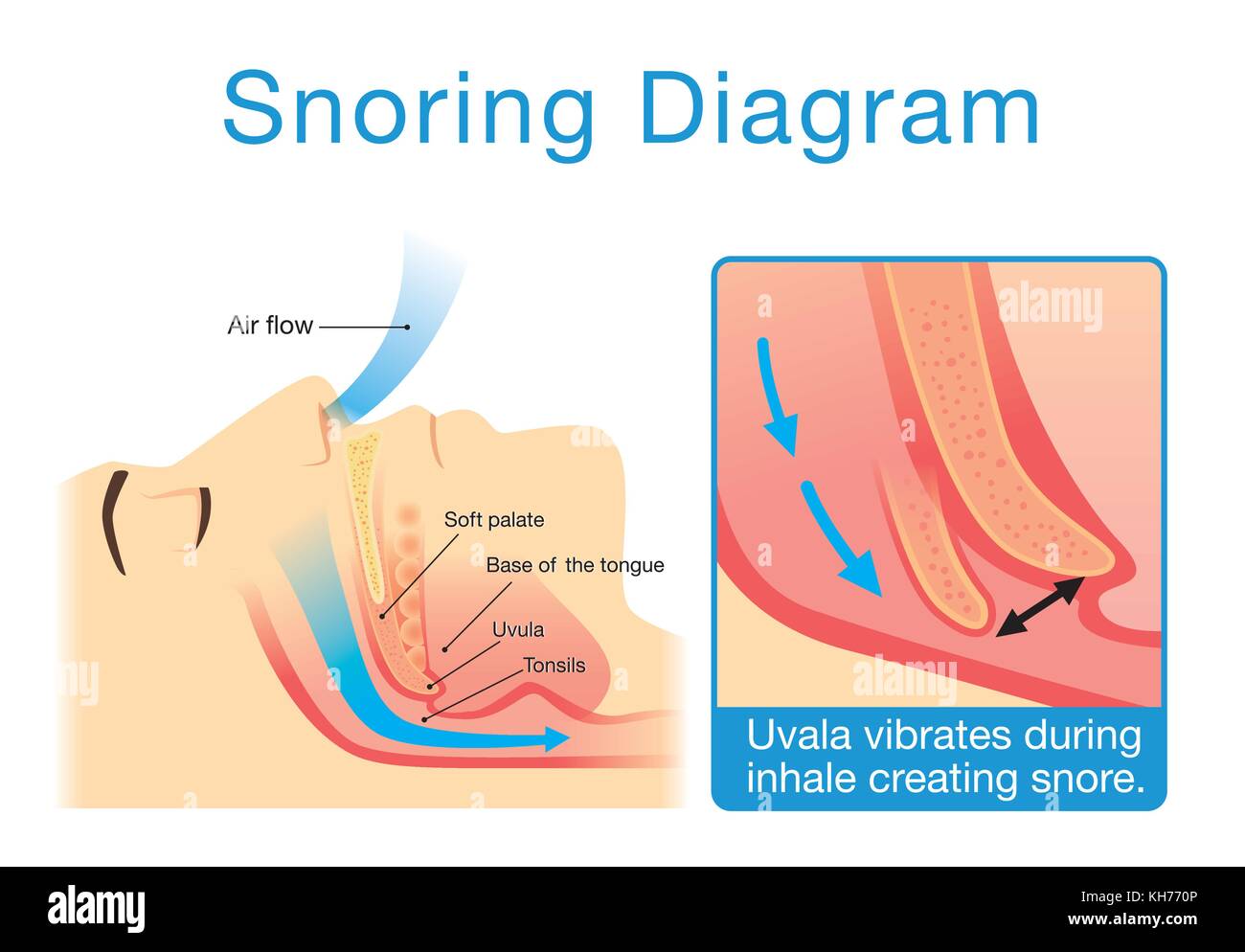 Anatomia umana di vie aeree superiori durante il sonno con il russamento. Illustrazione Vettoriale