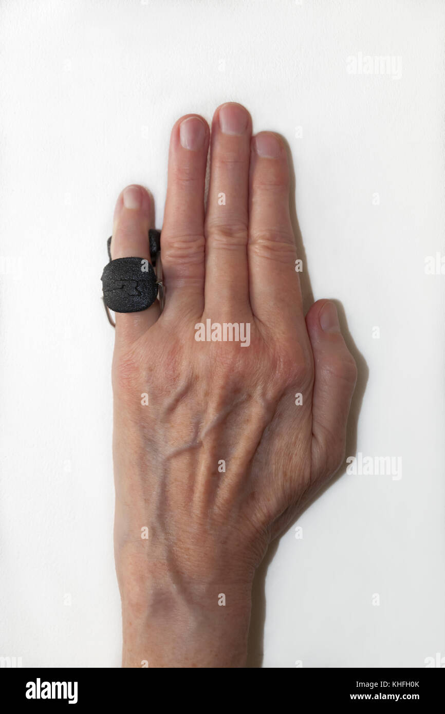 Fissatore del dito su un po' di pinkie' dito dopo Dupuytren contrattura della chirurgia correttiva per raddrizzare il dito e rimuovere il tessuto cicatriziale. Foto Stock