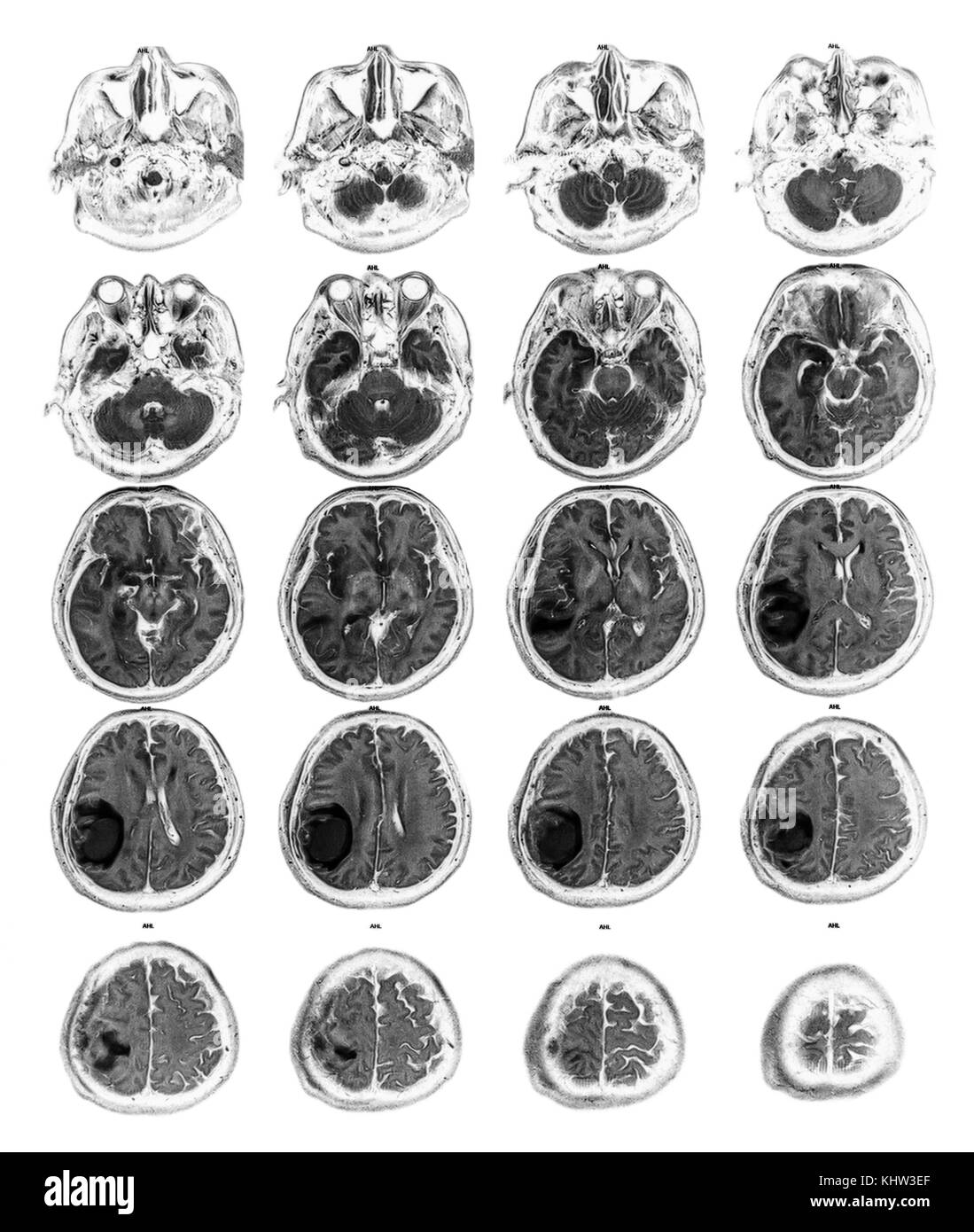 Cervello di MRI mostra tumore al cervello a destra lobi parietali . Foto Stock