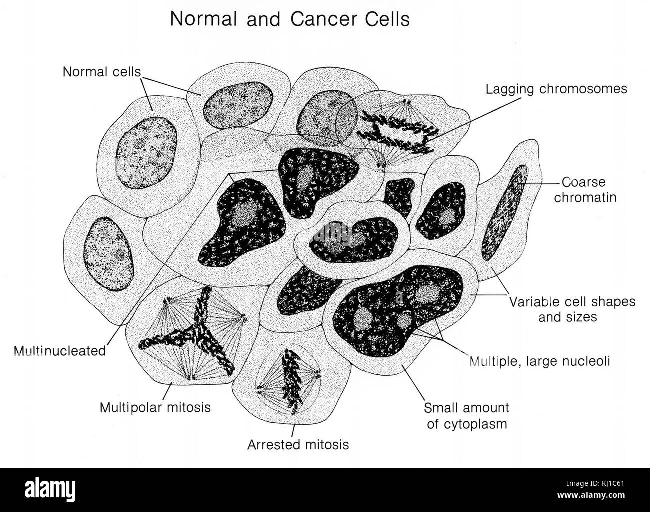 Normale e cellule cancerose (marcato) illustrazione Foto Stock