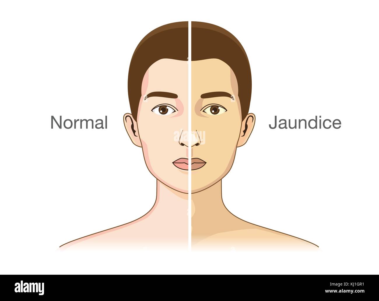 Il confronto tra la pelle normale persone Illustrazione Vettoriale
