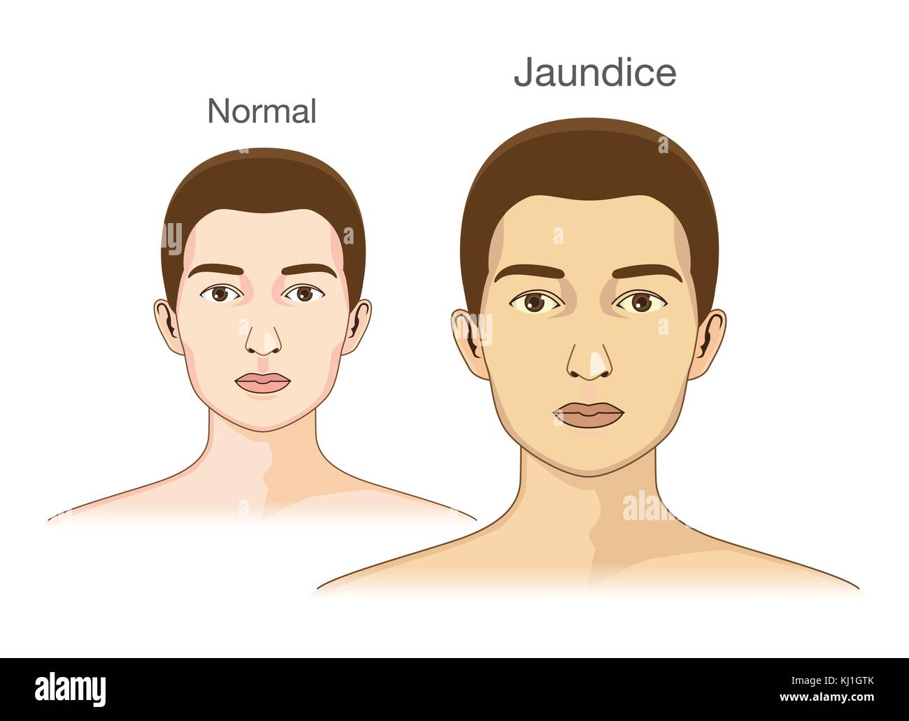 Il confronto tra la pelle normale persone e ingiallimento da ittero. Illustrazione Vettoriale